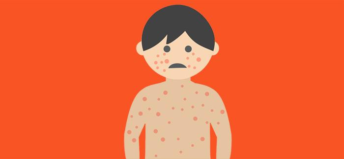 Augmentation du nombre de cas de rougeole en France : la vaccination est la seule protection